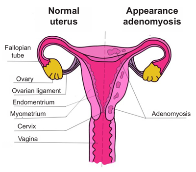 adenomyosis appearance illustration
