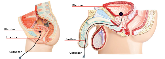 A diagram showing how a urethral catheter is inserted and connected to the male and female bodies.