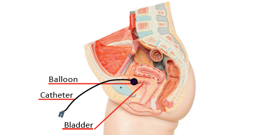 A diagram showing how a supra-pubic catheter is inserted and connected to the human body.