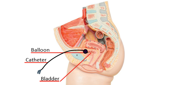 How to Care for Your Urinary Catheter