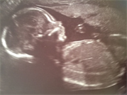 babyscan